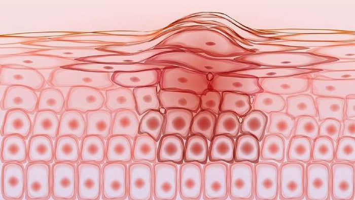 Inflammation